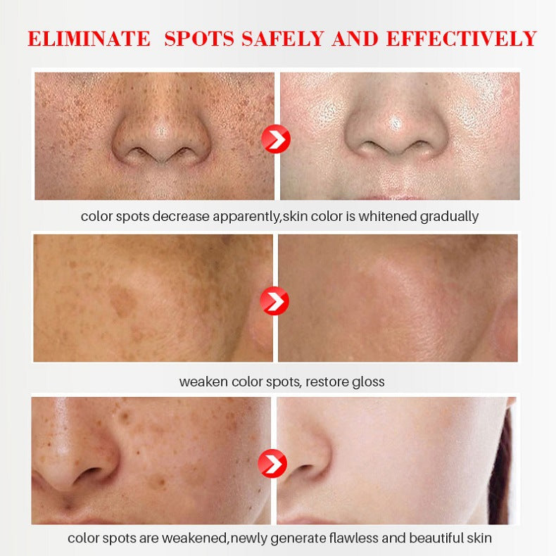 Whitening And Freckle Removing Cream Fade Spots Gently